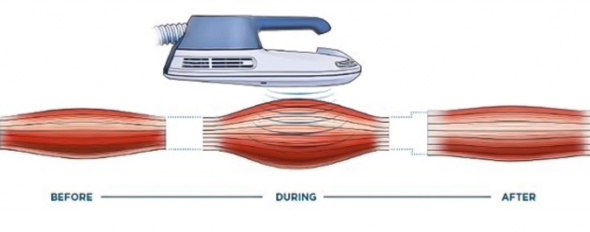 Magnetic Muscle Stimulation